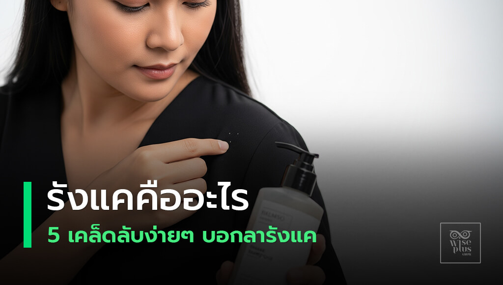 รังแคคืออะไรและวิธีแก้ง่ายๆ