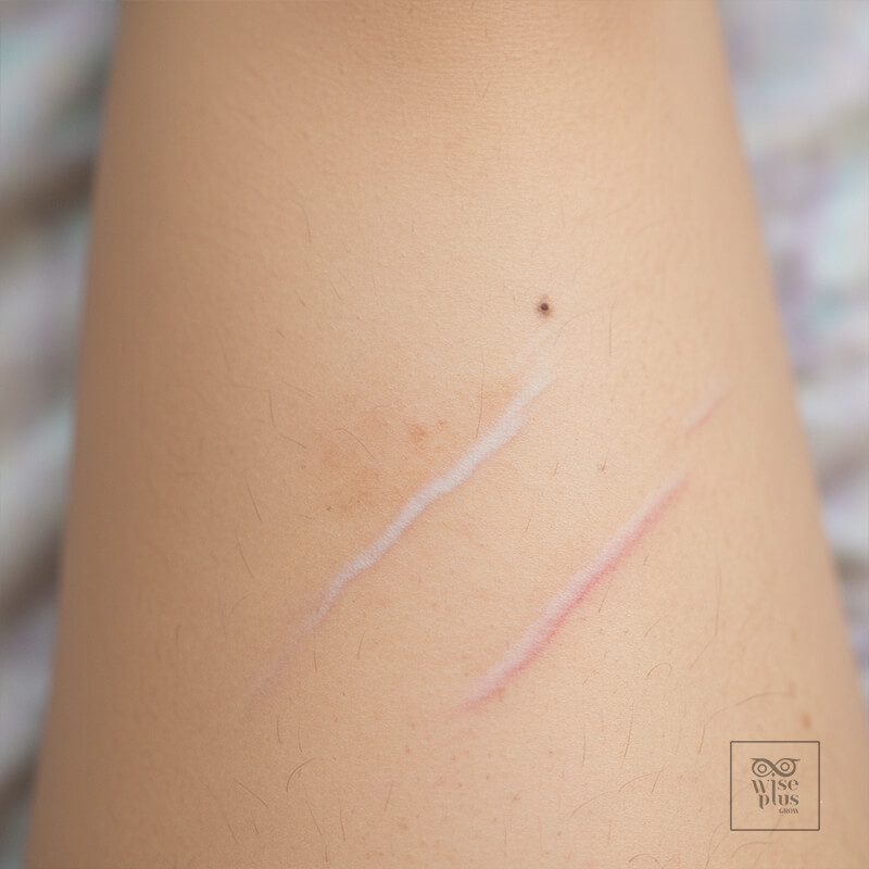 ชนิดของผิวลายและจุดด่างดำที่พบบ่อย